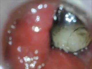 anal endoscope irritant carry on foreign dominant